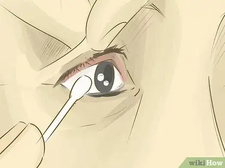 Image titled Remove Something from Your Eye Step 6