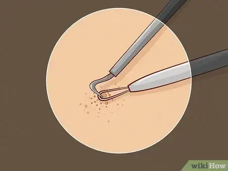 Image titled Close Blackhead Holes Step 12