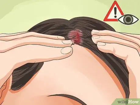 Image titled Diagnose Scalp Psoriasis Step 4