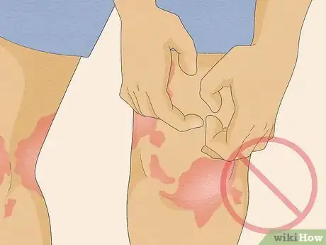 Image titled Use Apple Cider Vinegar for Psoriasis Step 10