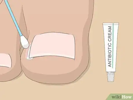 Image titled Relieve Ingrown Toe Nail Pain Step 18