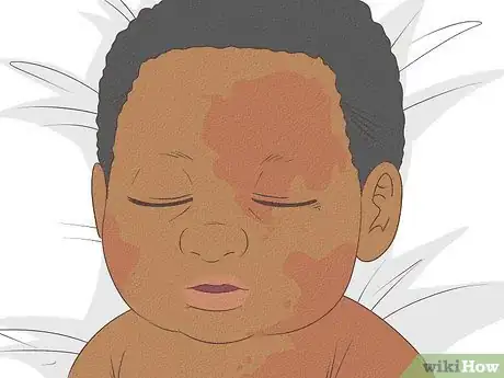 Image titled Know What to Expect on a Newborn's Skin Step 18