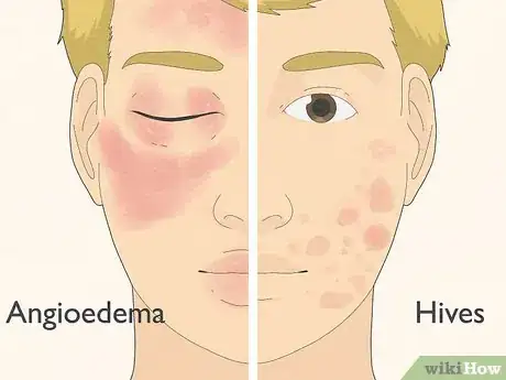 Image titled Recognize Hives (Rash) Step 4