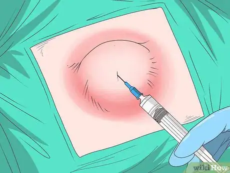 Image titled Drain a Cyst Step 1