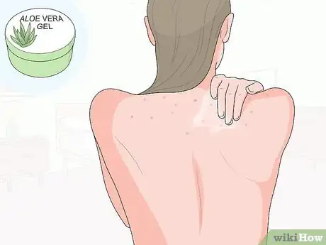 Image titled Naturally Get Rid of Back Acne Step 13