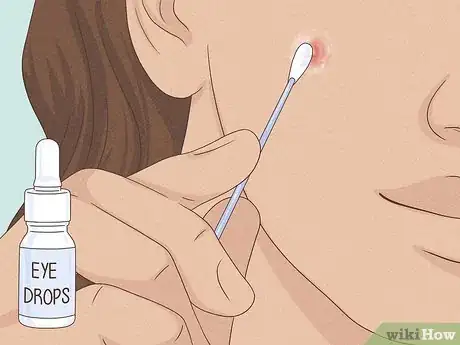 Image titled Get Rid of a Zit Overnight Step 9