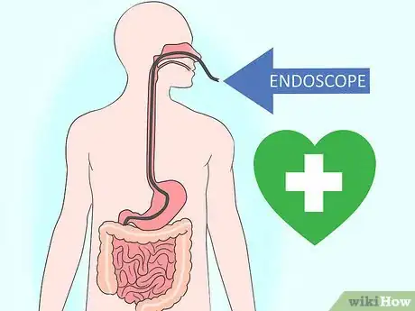 Image titled Diagnose Small Intestinal Bacterial Overgrowth (SIBO) Step 11