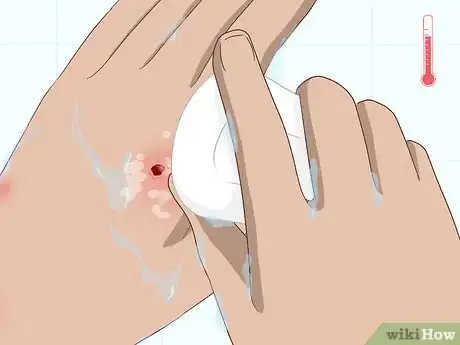 Image titled Heal Mosquito Bites Fast Step 10