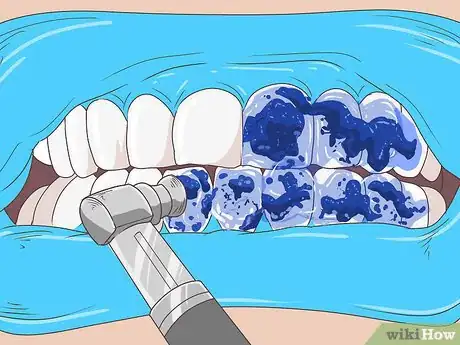 Image titled Remove Brown Stains from Teeth Step 7