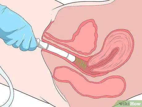 Image titled Recognize and Treat an Ectopic Pregnancy Step 11