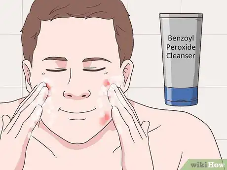 Image titled Get Rid of Acne Cysts Fast Step 8