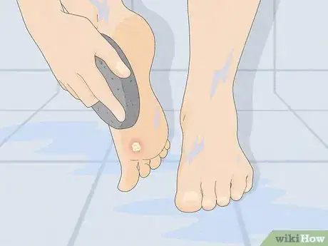 Image titled Get Rid of a Wart at the Bottom of Your Foot Step 2