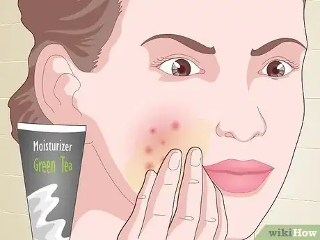 Image titled Prevent Acne Naturally Step 12