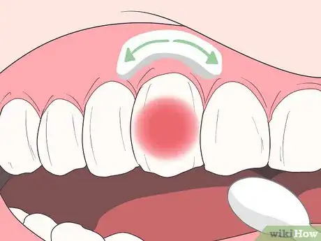 Image titled Stop Toothache Pain Fast Step 15