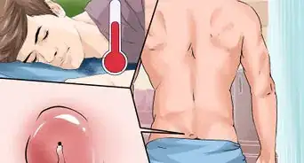 Treat a Pilonidal Cyst