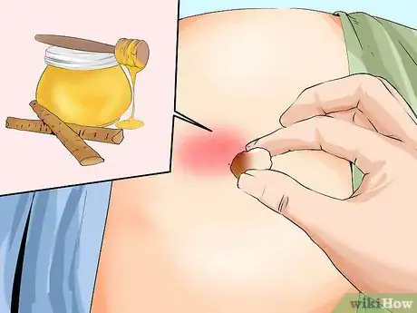 Image titled Treat a Pilonidal Cyst Step 8