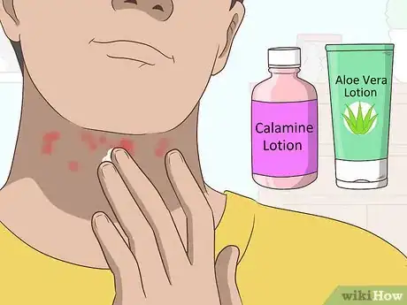 Image titled Treat a Rash on the Neck Step 15