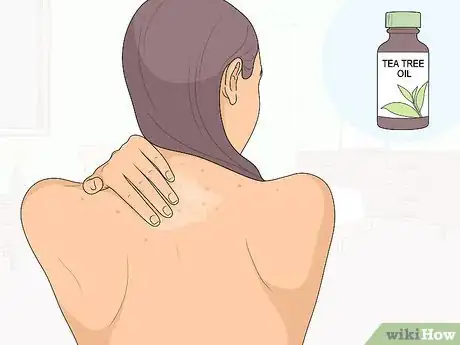 Image titled Naturally Get Rid of Back Acne Step 11