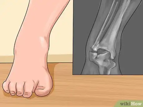 Image titled Know if You've Sprained Your Ankle Step 9