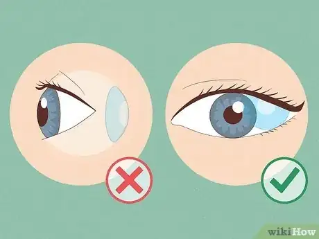 Image titled Tell if Contact Lens Is Still in Eye Step 1