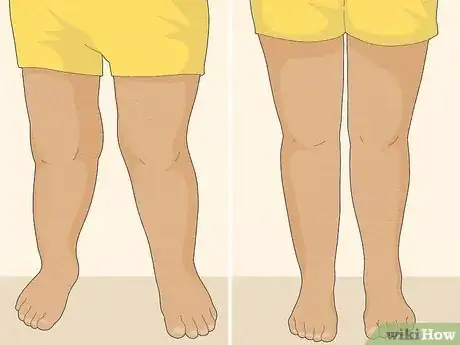 Image titled Fix Knock Knees Step 20