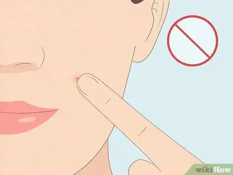 Image titled What to Do After Removing Pimple Patch Step 7