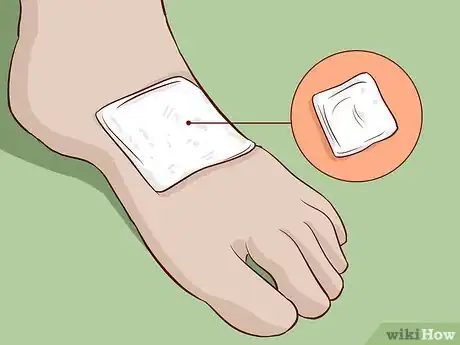 Image titled Treat a Foot Burn Step 11