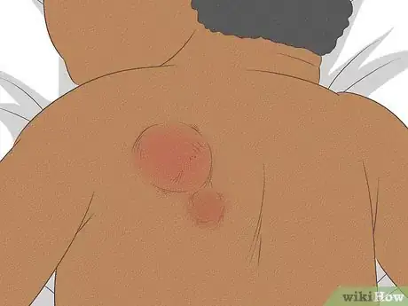 Image titled Know What to Expect on a Newborn's Skin Step 19