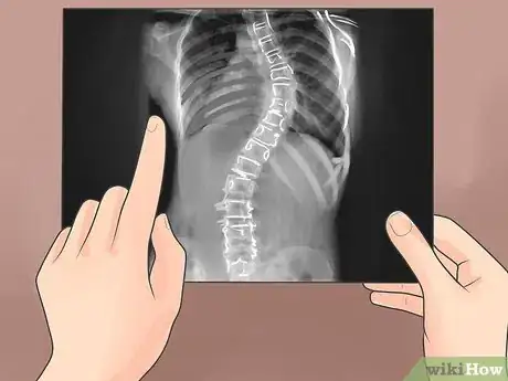 Image titled Treat Scoliosis Step 6