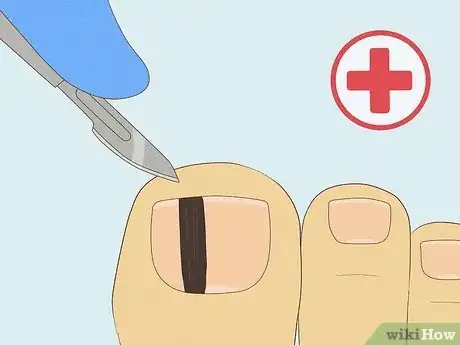 Image titled Treat a Black Toenail Step 15