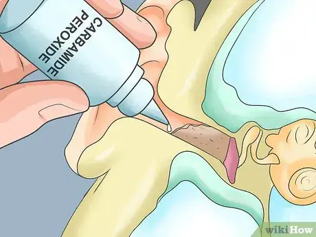 Image titled Remove Wet Wax from Infected Ears Step 5