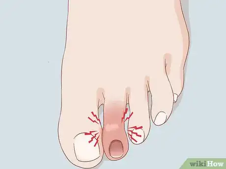 Image titled Treat a Swollen Toe Step 4