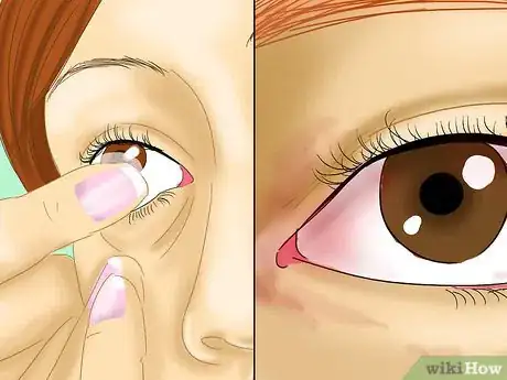 Image titled Determine if You Are Overwearing Your Contact Lenses Step 10