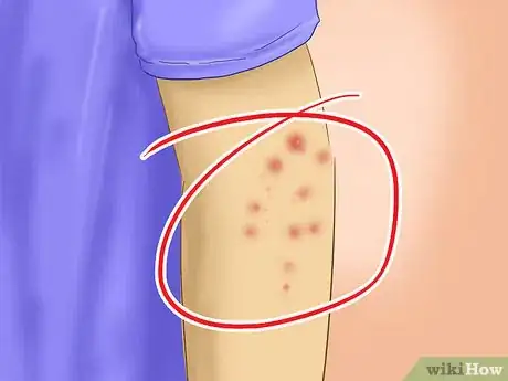 Image titled Avoid Catching Scabies Step 7