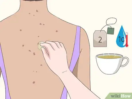 Image titled Get Rid of Back Acne Scars Step 7