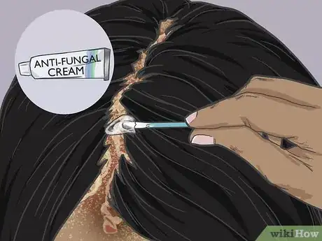 Image titled Grow Hair Back After a Scalp Fungal Infection Step 3