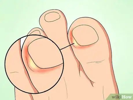 Image titled Tell if an Ingrown Toenail Is Infected Step 3