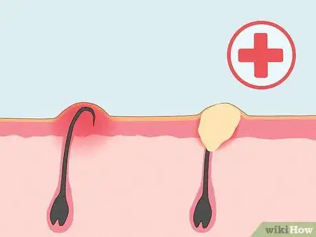 Image titled Prevent Ingrown Hairs on Your Bikini Line After Waxing Step 12