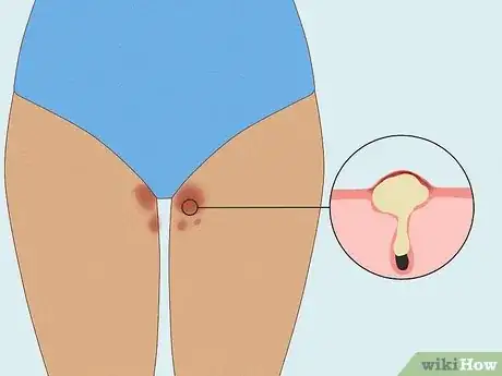 Image titled Get Rid of a Rash Between Your Legs Step 11