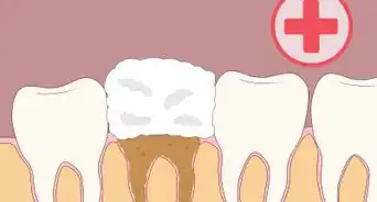 Prevent Dry Socket After a Tooth Extraction