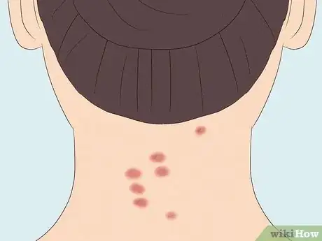 Image titled Identify Insect Bites Step 3