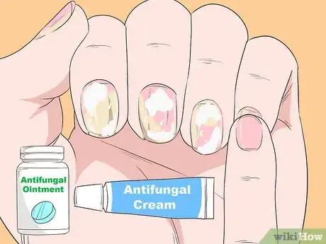 Image titled Get Rid of Psoriasis on Your Nails Step 8