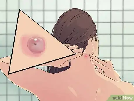 Image titled Remove a Sebaceous Cyst Step 1