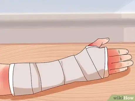 Image titled Apply a Cast to a Broken Arm Step 11