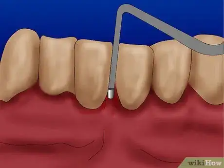 Image titled Get Rid of Gingivitis Step 4Bullet1