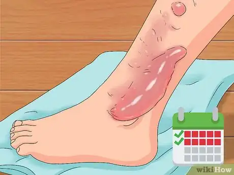 Image titled Determine if a Burn Is Infected Step 7