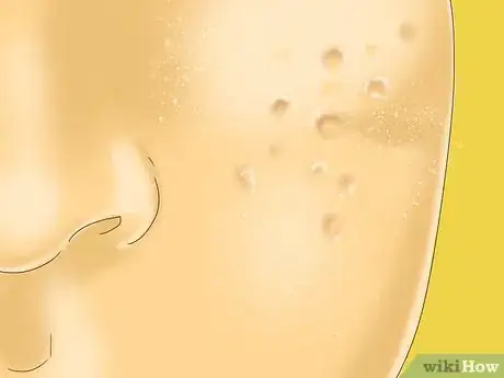 Image titled Hide Acne Scars Step 14