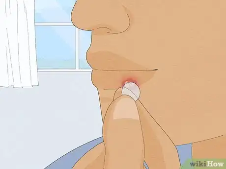 Image titled Get Rid of a Cold Sore Fast Step 3