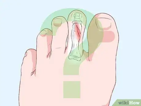 Image titled Bandage Fingers or Toes Step 6