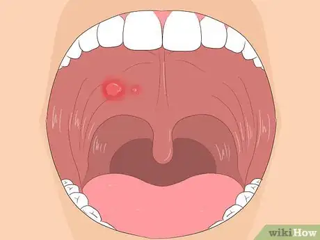 Image titled Get Rid of Mouth Blisters Step 13